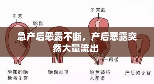 急产后恶露不断,产后恶露突然大量流出