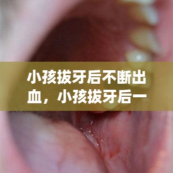 小孩拔牙后不断出血,小孩拔牙后一直流血怎么处理